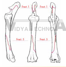 Equine Radius/Ulna, fractured Fracture set 2